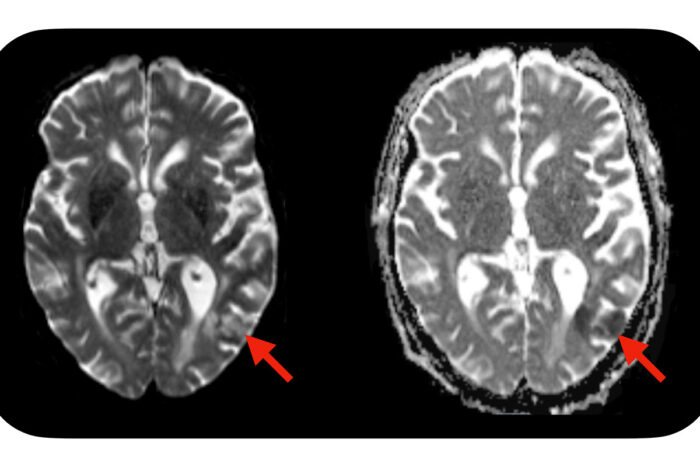 Simple Blood Test Predicts Neurotoxic Complications Of CAR T Cell