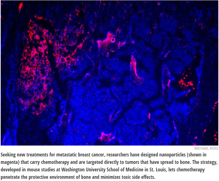 Chemo-loaded nanoparticles target breast cancer that has spread to bone
