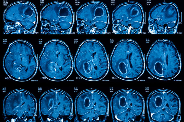 Brain cancer vaccine effective in some patients