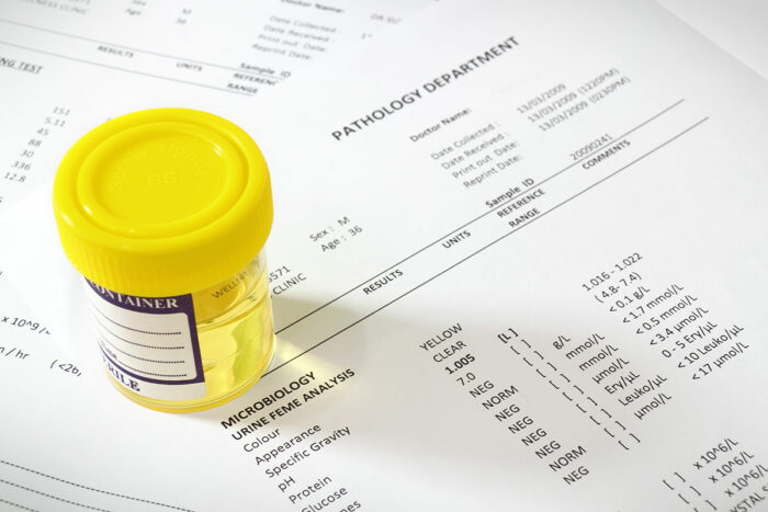 Unnecessary testing for UTIs cut by nearly half