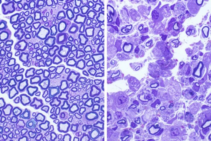 Cause of rare, fatal disorder in young children pinpointed