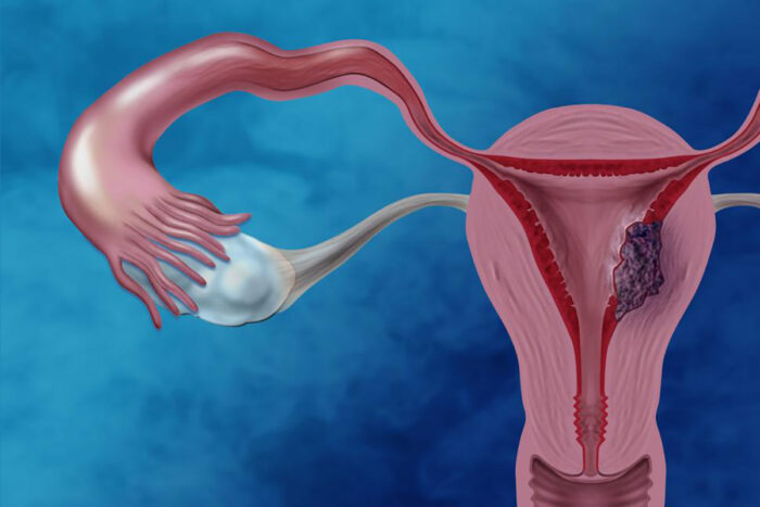 Fight against endometrial cancer boosted with new molecular road map
