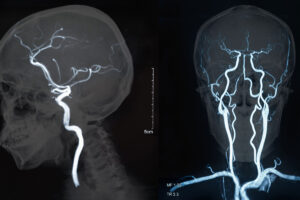 Stroke survival rates worse in rural areas, study says
