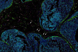 Shown is a human breast tumor sample. The white arrows point to senescent cells in the tumor. Eliminating senescent cells, which drive inflammation, could become a new treatment strategy aimed at making immunotherapies and chemotherapies more effective. (Image: Stewart lab)