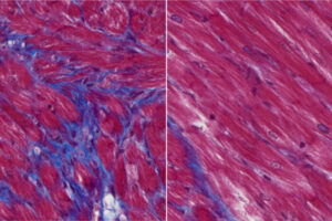 Researchers at WashU Medicine have reduced scar formation and improved heart function in mouse models of heart failure using a monoclonal antibody treatment. Untreated mice develop major scarring after cardiac injury (purple tissue, left) while treated animals show much less scarring (right). The findings point to the possibility of developing such immunotherapies for heart failure in patients who have experienced a heart attack or other injury.