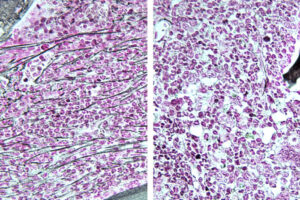 Research from WashU Medicine found a possible new treatment strategy for certain types of blood cancers. The bone marrow of a mouse with a myeloproliferative neoplasm (left) shows fibrosis, or scar tissue (horizontal lines). A mouse with the same disease treated with an RSK1 inhibitor shows bone marrow resembling normal tissue (right).