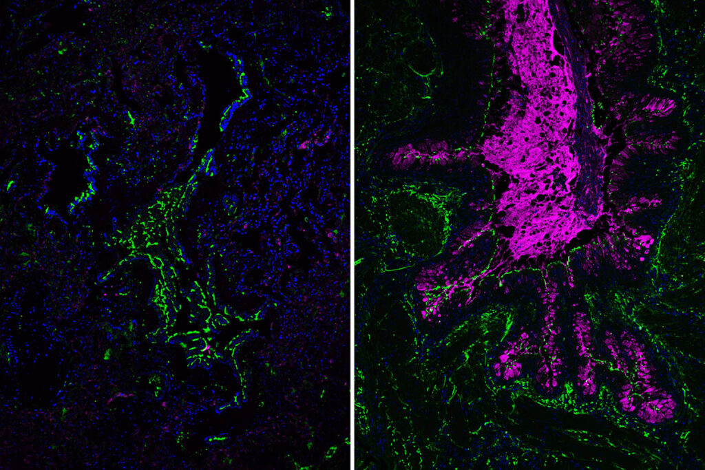 Normal lung tissue is shown on the left. On the right is lung tissue from a person with primary ciliary dyskinesia with a CCDC39 mutation. A large mucus plug is visible in magenta, demonstrating the severe airway problems seen in such patients with these specific mutations. (Image: Brody lab/WashU Medicine)