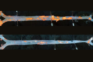 An immunotherapy reduces plaque in the arteries of mice, offering a potential new strategy to treat cardiovascular disease, according to a study led by WashU Medicine researchers. An artery from an untreated mouse (top) shows more plaque (orange) than that of a mouse treated with the antibody-based immunotherapy (bottom).