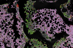 Researchers at WashU Medicine and their collaborators have created an immune cell atlas of multiple myeloma, a cancer of the bone marrow. The new resource could improve prognosis and guide development of new immunotherapies. Shown is a sample of bone marrow from a patient with multiple myeloma, indicated by an overabundance of plasma cells (pink) compared with normal bone marrow (green). T cells are in red.