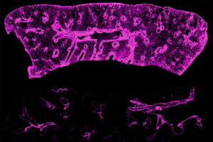 A new study from researchers at WashU Medicine has identified lymphatic vessels and their cargo — a sugar molecule called hyaluronan (shown in pink) — as critical drivers of chronic rejection in transplanted lungs and hearts. A lung transplanted between genetically identical mice is laden with scar tissue full of hyaluronan (top half of image). Following a treatment to promote growth of lymphatic vessels, hyaluronan accumulation is markedly reduced (bottom).