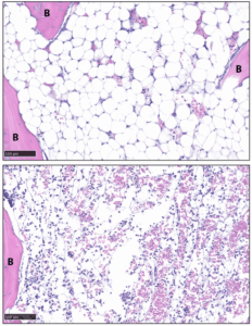 Fat cells called stable adipocytes (shown in white in the top image) were depleted completely from the bone (B) in mice after nine days of treatment, as shown in the bottom image. (Image courtesy of the Scheller lab)