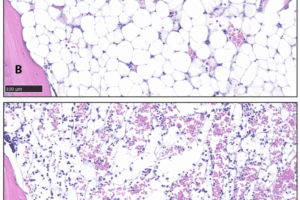 Specific brain signals rapidly eliminate body fat in mice