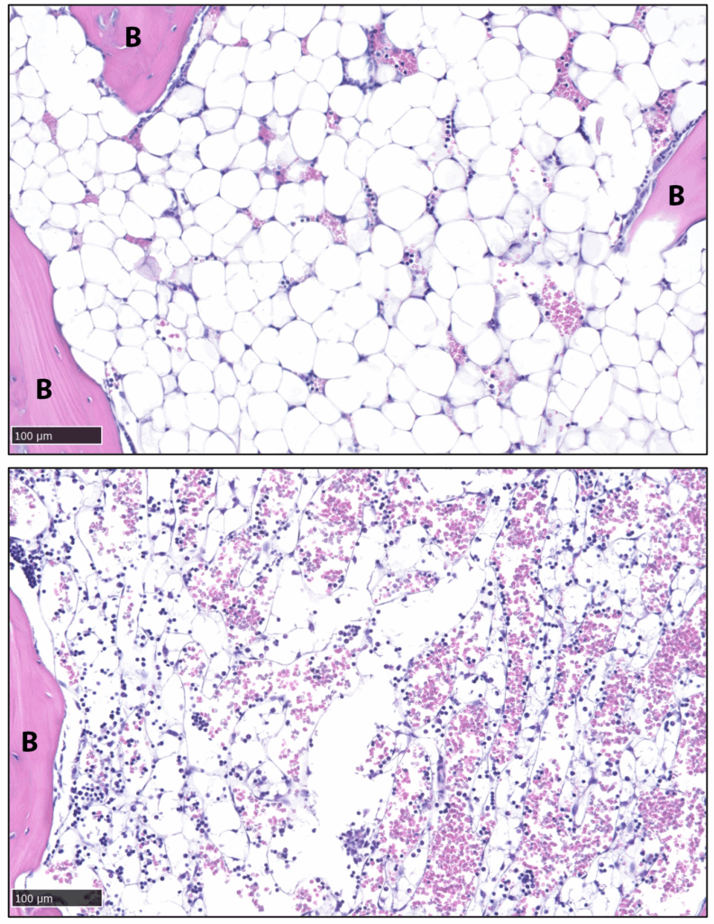 Fat cells called stable adipocytes (shown in white in the top image) were depleted completely from the bone (B) in mice after nine days of treatment, as shown in the bottom image. (Image courtesy of the Scheller lab)