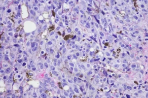 Micrograph-of-melanoma-1024x678.jpg