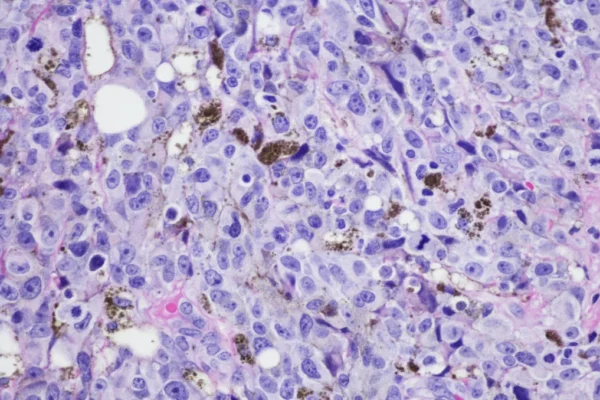 mRNA-Based Therapy Offers New Hope Against High-Risk Melanoma