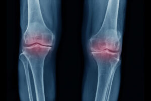 x-ray image of OA knee AP and lateral view