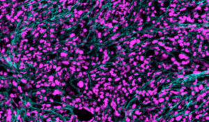 A new NIH grant to WashU Medicine supports research into myeloproliferative neoplasms (MPNs), a group of blood cancers. In an MPN called myelofibrosis, reticulin fibers (in cyan) infiltrate the bone marrow. (Photo: Oh lab/WashU Medicine)