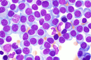 Shown are multiple myeloma cells from a patient. An international phase 3 clinical trial led by Washington University School of Medicine in St. Louis has shown that the investigational drug motixafortide — when combined with the standard therapy for mobilizing stem cells — significantly increased the number of stem cells that can be harvested, compared with treatment with the standard agent alone. If approved, the combination with motixafortide potentially would improve stem cell transplantation for multiple myeloma patients.