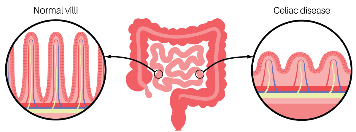 Celiac Disease Program - John T. Milliken Department of Medicine