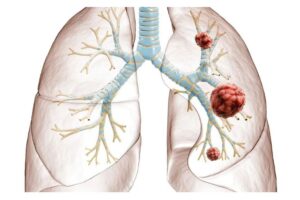 AI may predict spread of lung cancer to brain