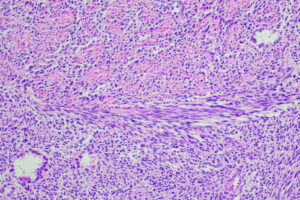 According to a study led by Washington University School of Medicine in St. Louis, a new T cell immunotherapy — in which the patients’ own T cells are genetically modified to attack and kill cancer cells — is effective in treating some patients with two types of sarcoma, rare cancers of the body’s soft tissues. Shown is a cross section of a synovial sarcoma tumor.